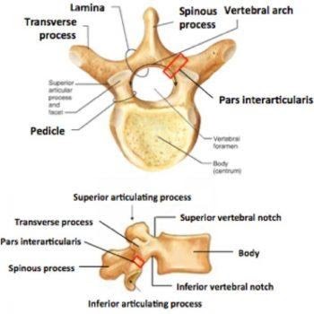 Labelled diagram of a lumbar vertebra from above and side, marking the pars interarticularis