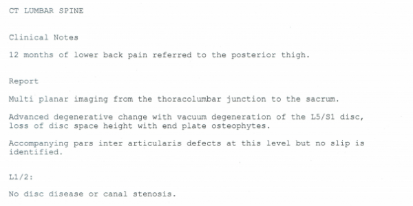 Extract from a CT lumbar spine report describing degenerative disc change at L5/S1