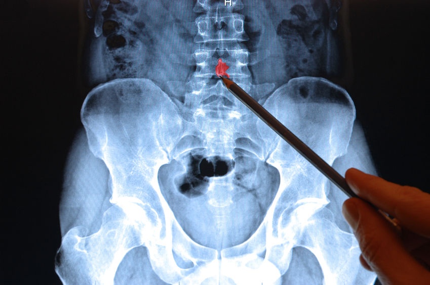 allforone - xray_low_back_pelvis26651198_M