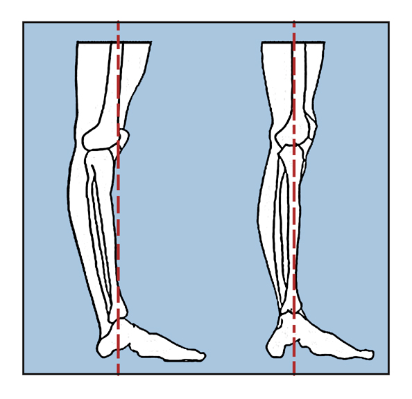 allforone - Hypermobile-physio