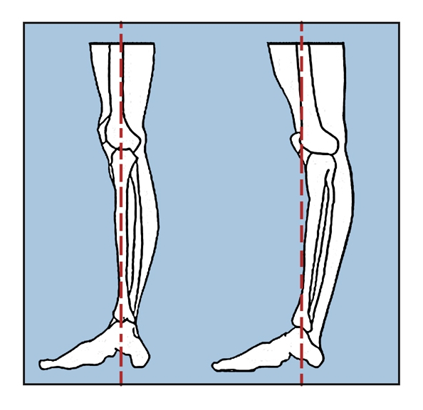 hypermobile physiotherapy