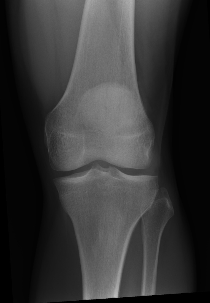 allforone - knee-xray