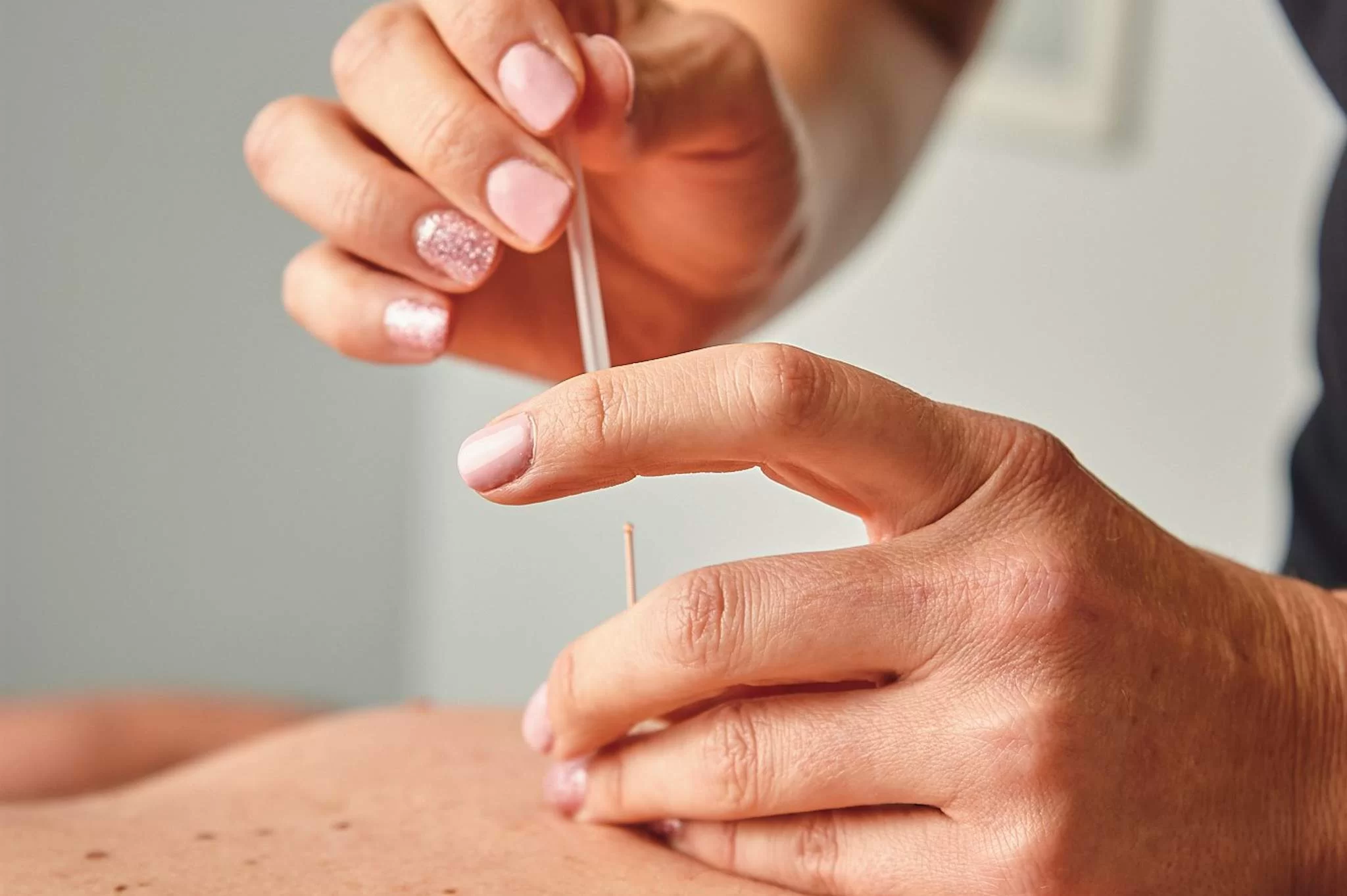 allforone - dry-needling-physiotherapy