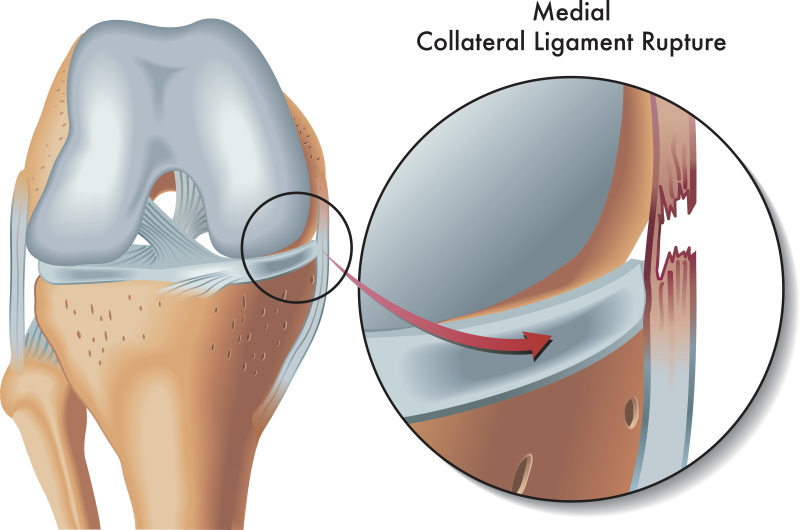 allforone - mcl-knee-physio