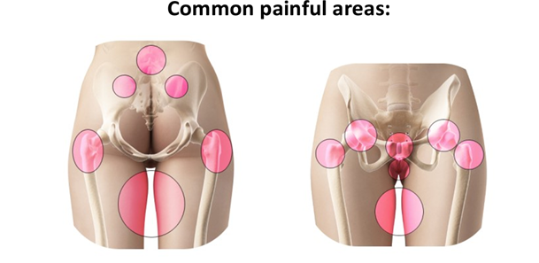Diagram showing common pelvic girdle pain areas across the pelvis, groin and hips during pregnancy.