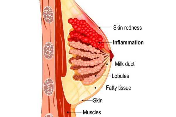 Diagram of mastitis in the breast showing inflammation around a milk duct, skin redness, lobules and fatty tissue
