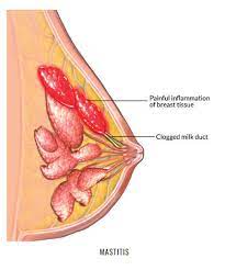allforone - mastitis-treatment